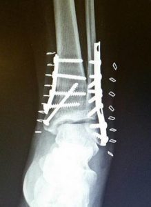 My new titanium ankle!